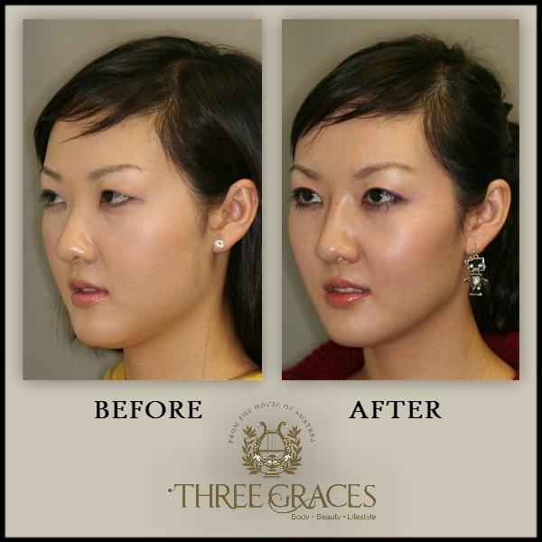 ThreeGracesIn's tweet photo. Get that slimmer jawline you have always wished for  with #Botox Treatment at Three Graces! http://t.co/NfixtiBQS6