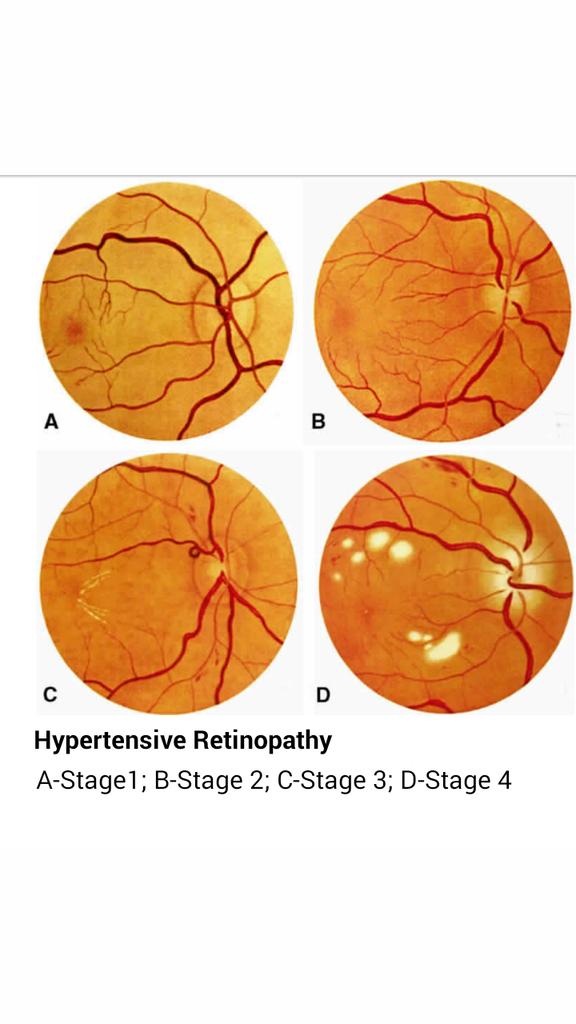 Eye Atlas on Twitter "Hypertensive Retinopathy Memorize