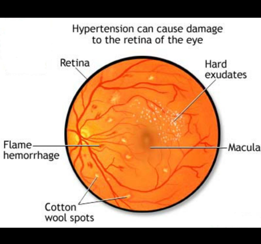 глазное дно при гипертонии. артериальная гипертензия глаз. ретинопатия артериальной гипертензии. глазное дно при гипертонической ангиопатии. повышенное глазное давление.