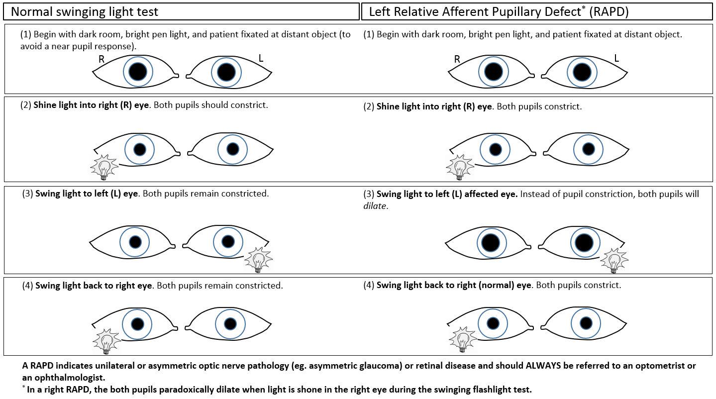 CMAJ on Twitter: "Swinging light test to detect a relative afferent