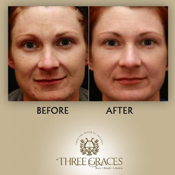 ThreeGracesIn's tweet photo. See instant reduction in the red spots with the Cosmelan mask treatment at #ThreeGraces. Look flawlessly beautiful! http://t.co/zJsuKKInzb