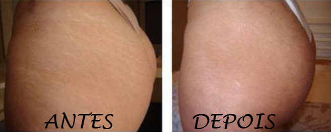 CONFIRA DICAS INCRIVEIS PARA ACABAR COM AS ESTRIAS!! goo.gl/bVvLAo