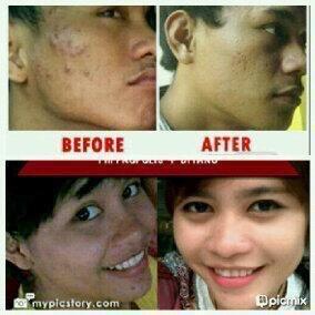 QueenAngelina99's tweet photo. Jerawat ?? Bukan masalah !! Masker Spirulina dan Vitaline dgn Harga MURAH ?? PIN 2AEA2624 / 08990431965 http://t.co/adXUJ45M85