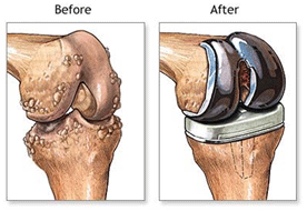 kneejointcare's tweet photo. #Computer_Assisted_Surgery allow faster recovery than traditional #Joint_Replacement surgery
http://t.co/dnYjiD8dWR http://t.co/ayuIuGXBzb