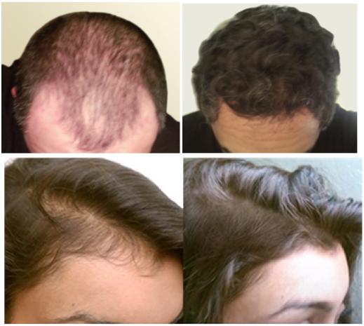 Theradome On Twitter Thinning Hair Inventor Tamim Hamid Will Be