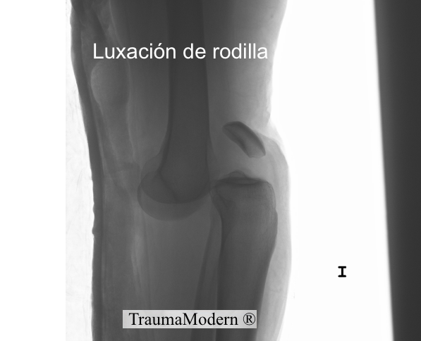 trauma_modern's tweet photo. Luxación traumática de rodilla: lesión poco frecuente y alto riesgo de lesión vascular asociada. http://t.co/22rYO61pBi
