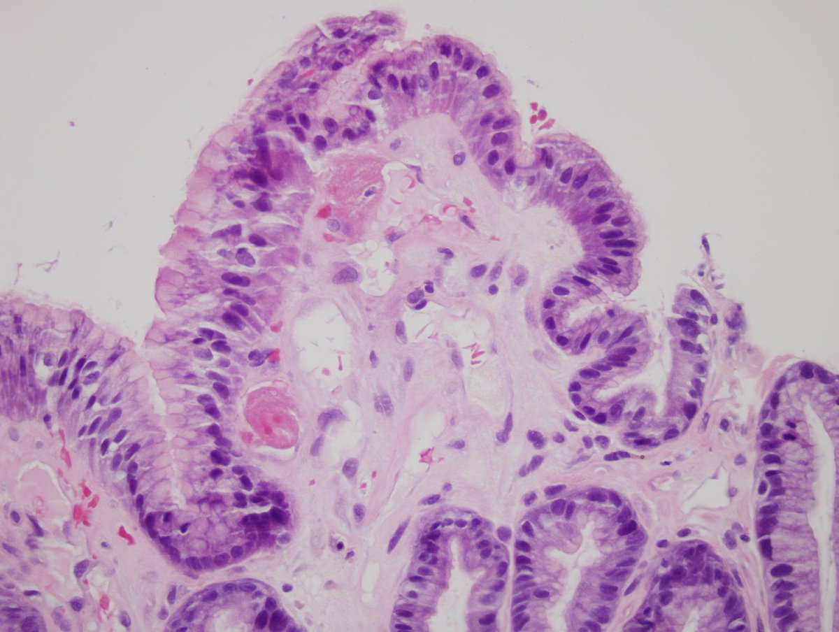 Hopkins Gi Pathology On Twitter Gastric Antral Vascular Ectasia Watermelon Stomach Dilated Vessels With Fibrin Thrombi Can Bleed Pathologists Http T Co Xipuazytyc Twitter