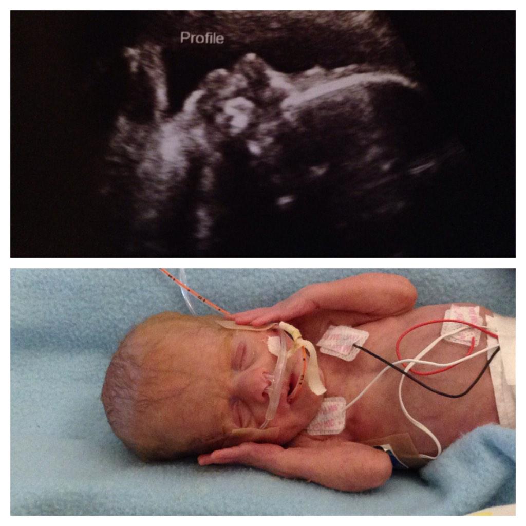Colton_Ragan's tweet photo. Roe V Wade anniversary. Both my boys at 29 weeks. Are they human? Both or just one of them? http://t.co/sm18OXh45R