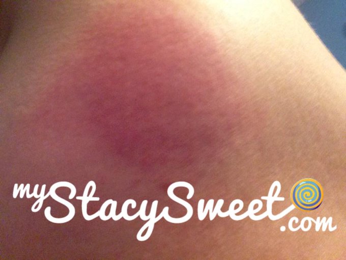 Holy buckets, woke up &amp; my ass is still bright red, no bruises yet. :( http://t.co/0Hzh9kYPzd