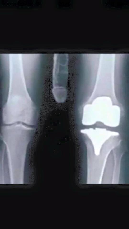 BigDMay's tweet photo. Routine check on my dodgy left knee......Everything looks completely normal #show-er http://t.co/o7R1G1GHJy
