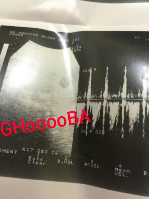 GHooooBA's tweet photo. سبب غيابي،واحد مينون نزل بكسي بدون لا ادري و رحت شفت اني حامل و سويت عمليه و الحين رديت لكم حبايبي http://t.co/cZomG0ZSDz
