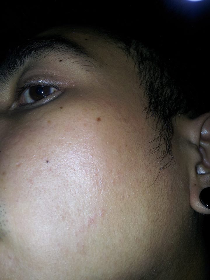 IceElements's tweet photo. #oilyskin #largepores #acne Learn how Moisturizing may be your answer. #Iceelements https://t.co/y7cfObj70b http://t.co/3IgWLvE4S4
