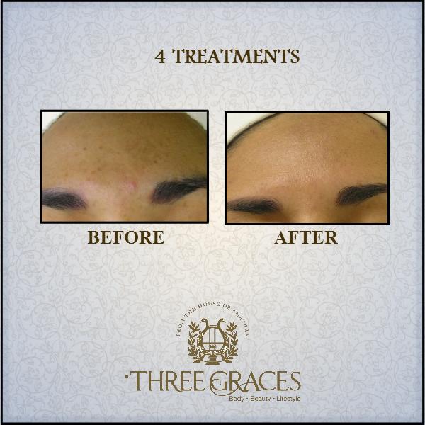 ThreeGracesIn's tweet photo. Troubled with the unwanted spots? Get clearer, glowing and younger looking skin with Hydra #facials at #ThreeGraces! http://t.co/UwM3zf3kjI