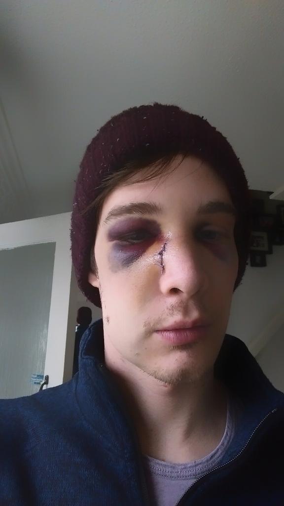 rsmonkman's tweet photo. @r70dger @markreeves22 @BarrieDuffill @FcRidings @malreeves64 @druryboy30 @MarkReeves25 @samnormy on the mend http://t.co/ElD5hsEX5t