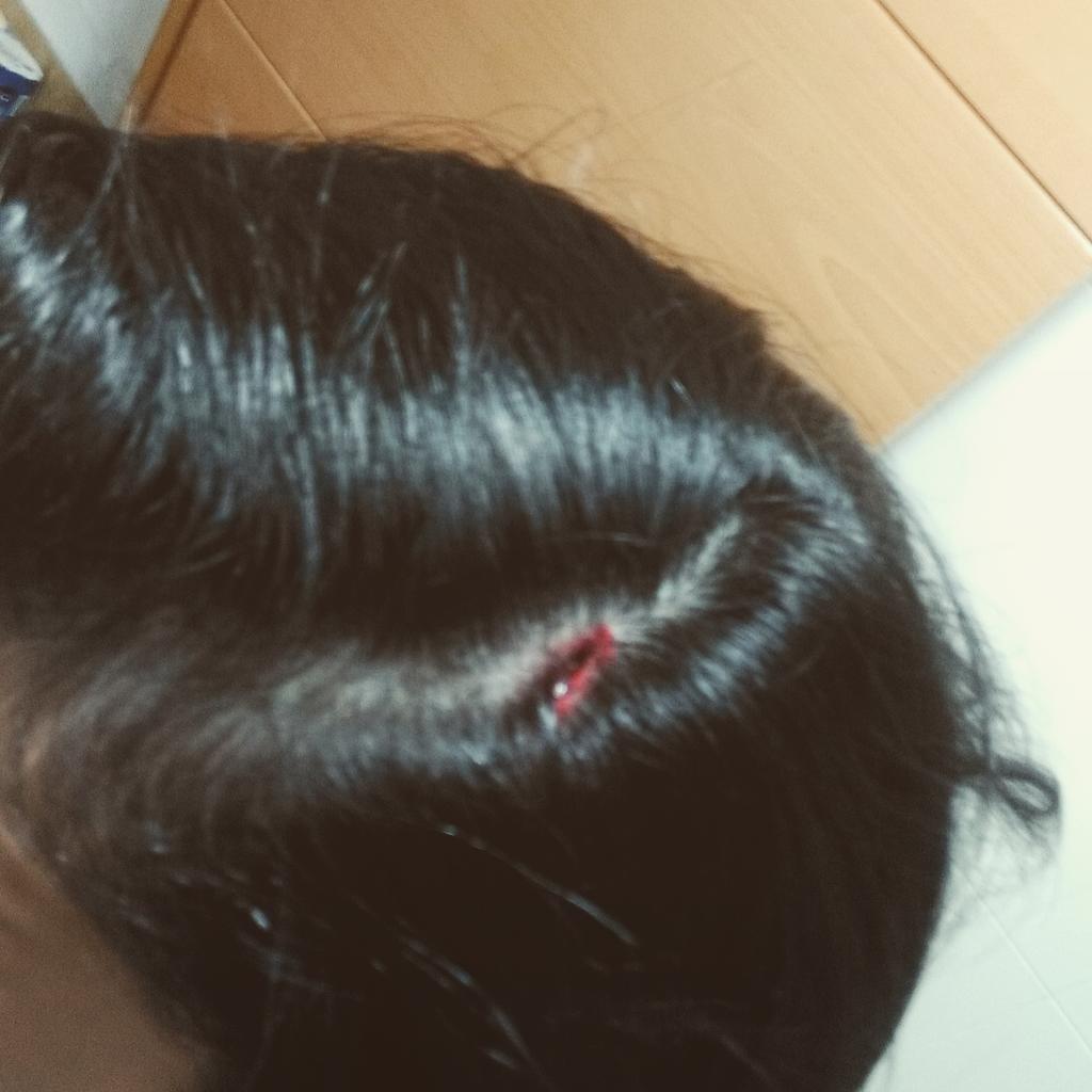bmcanchales's tweet photo. Pequeños accidentes laborales que se resumen en pitera con 5 grapitas 😑 http://t.co/GZ0p597MjV