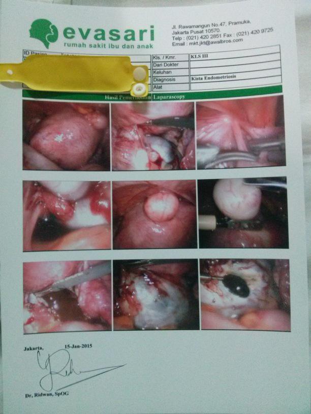 Laparoskopi kistektomi untuk kasus kista endometriosis @rsiaevasari #laparoskopiginekologi