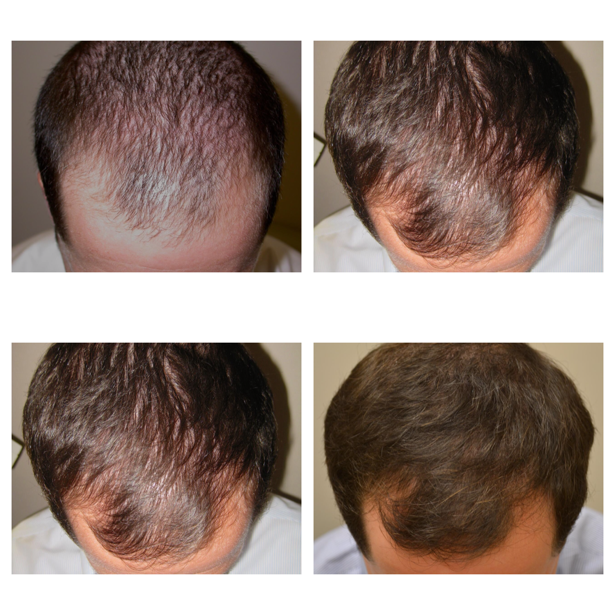 Minoxidil Kazakhstan on Twitter: "Photos taken Before and After 1-6 Months using of the Minoxidil 5%. Real Real results. Real photos. It works / Twitter