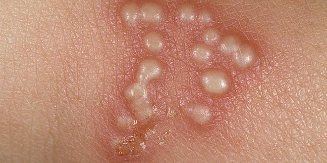 Ketahui Penyebab Dan Gejala Penyakit Herpes - AnekaNews.net