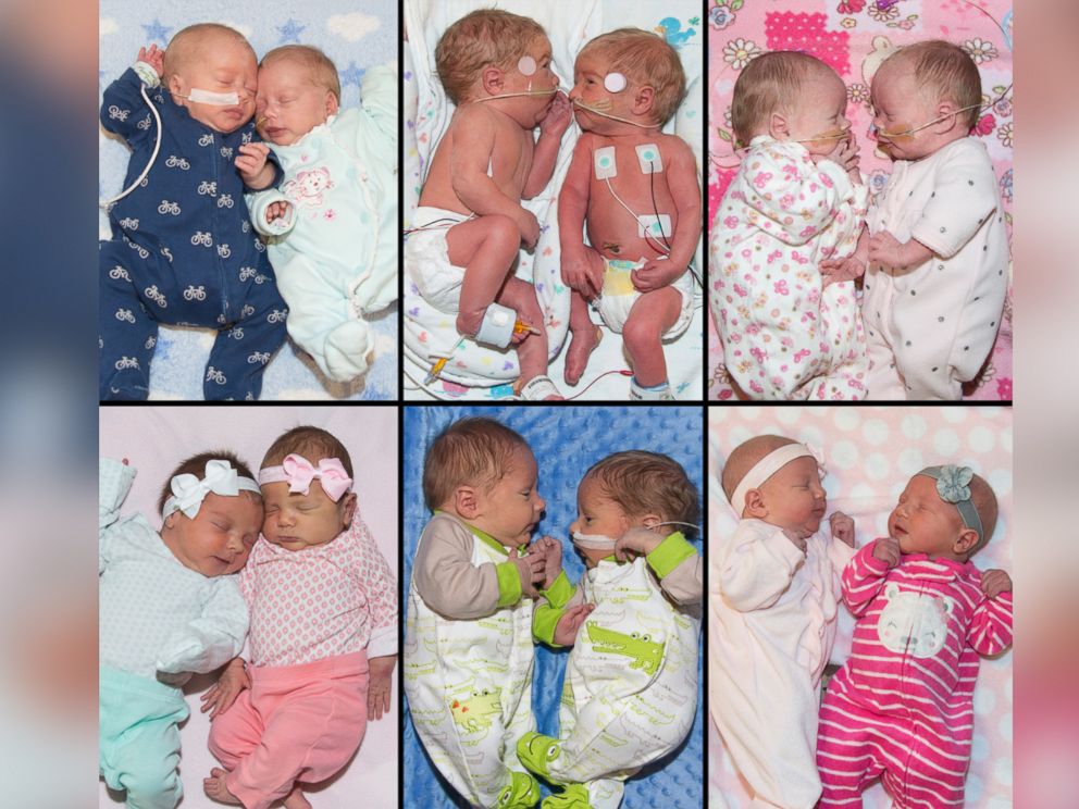 беременность двойней по неделям. 31 неделя беременности двойней. двойня недели. двойня недели. узи живота ребенку.