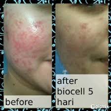miradharma's tweet photo. Biocell nutrisi kulit utk menghilangkan jerawat.

Order: 229DEFF3/www.mirads.moment4infinity.com
GRATIS ONGKIR http://t.co/C5mLtW28t7