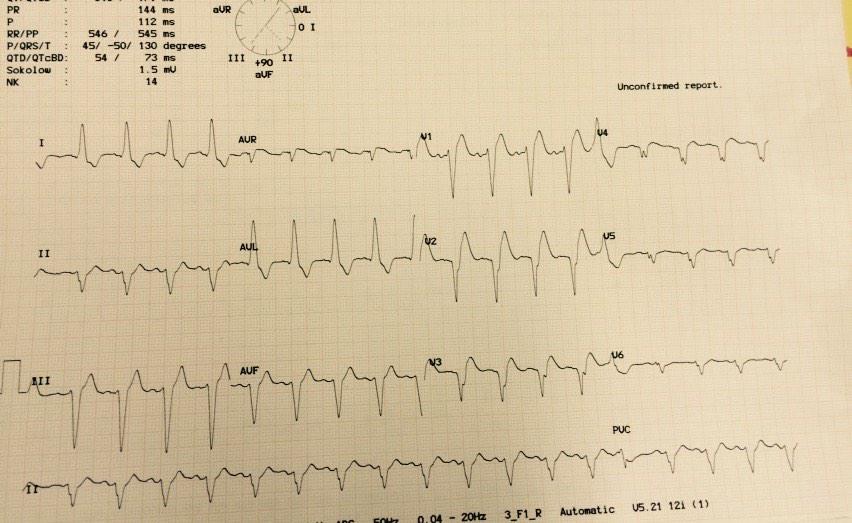 Dufourq's tweet photo. @smithECGBlog @EMcardiac post cardioversion http://t.co/dPydLnejOo