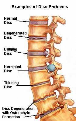Here is a great example of some common disc problems. We are here to help you! #chiropractic #backpain #chantilly