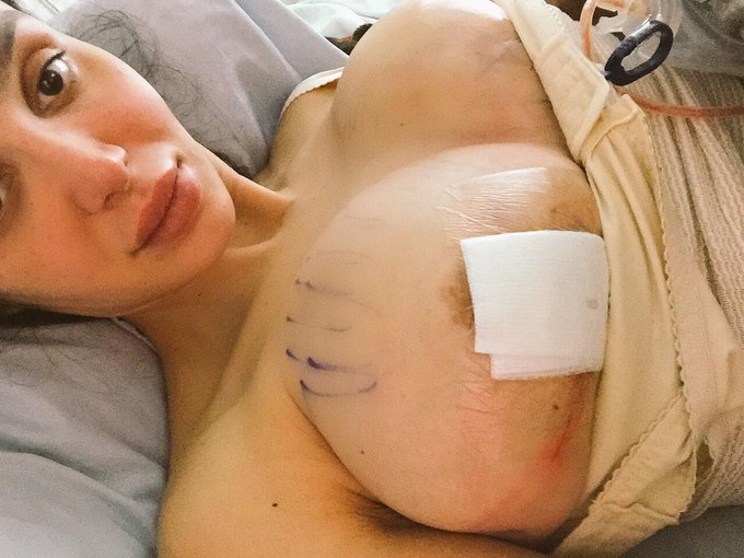 Here they are still very bruised and healing. http://t.co/Qab26q7Qnw