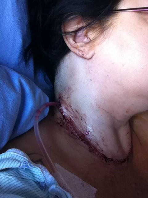 CancerCheerCard's tweet photo. August 25th, 2014 - 2nd Cancer surgery where 37 possible tumours were removed. 14 tumours tested positive for cancer. http://t.co/R2xReu4gi9