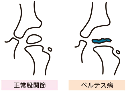 【ペルテス病】
・6~8歳の男児に多い
 ・片側性
・大腿骨骨頭の阻血性壊死
・跛行、運動時痛