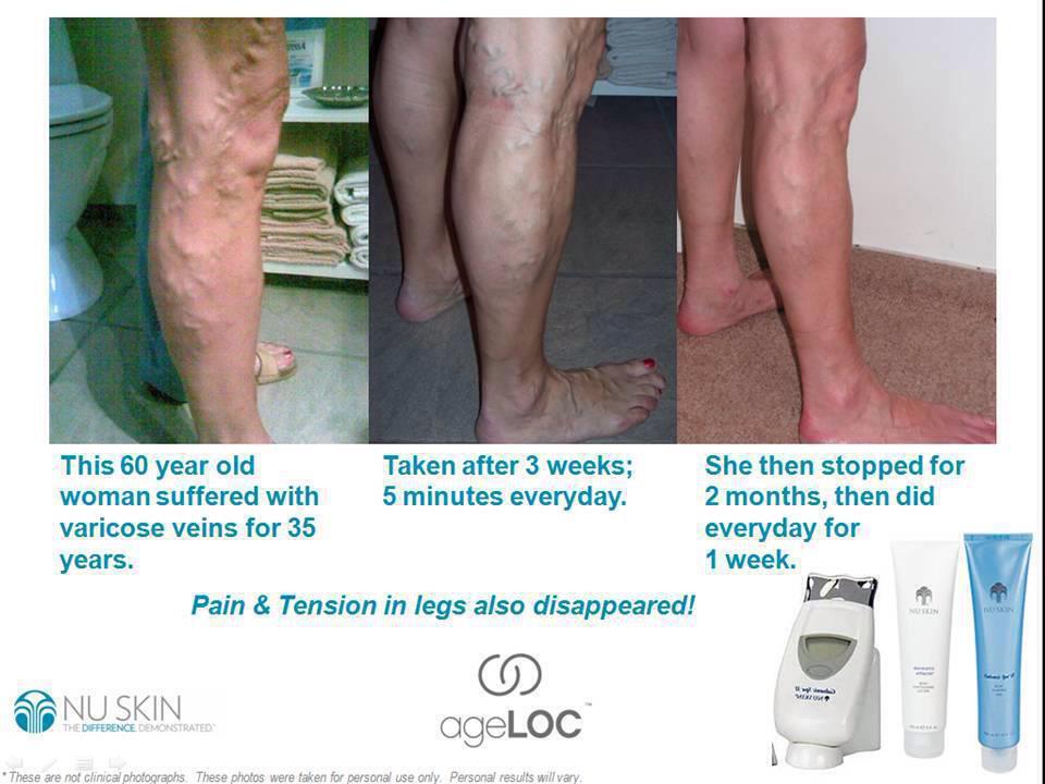 iKandiClinic's tweet image. Suffer from varicose veins? PM me for more information #ikandiclinic #nuskin #sheffieldissuper
