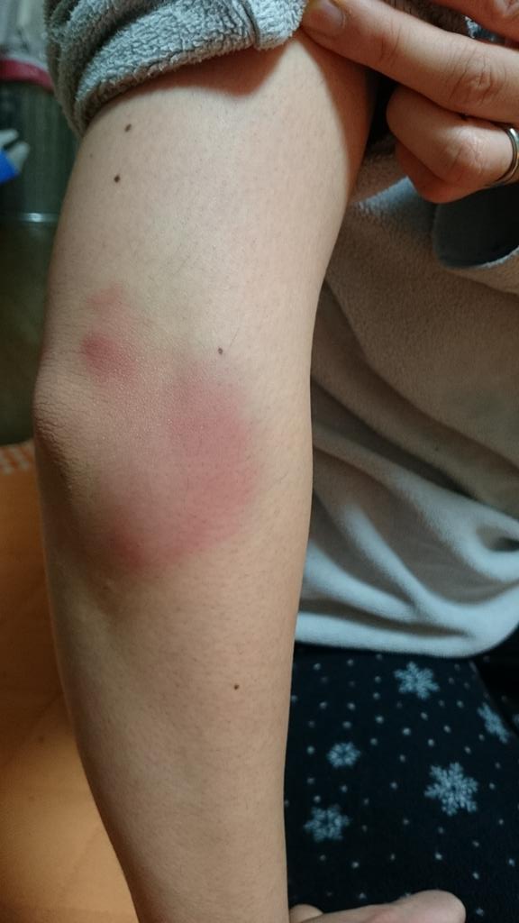 ぴよっち 肘が腫れて痛い C Http T Co Mw5kjdtlh8