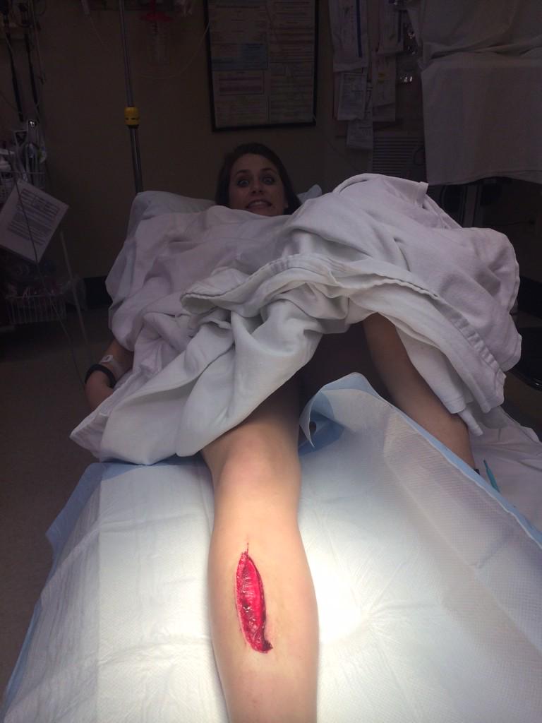 haymahl's tweet photo. 45 stitches later my bone is finally not exposed  :-) http://t.co/s1vrINm56X