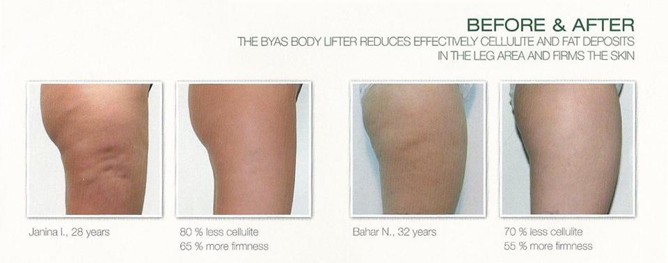 wellstar_uk's tweet photo. Eradicate cellulite and fat with the BYAS body lifter, same technology as £70,000 machines now available at home http://t.co/ErFLQrYYzq