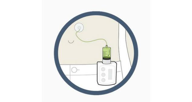 A pump for levodopa/carbidopa delivery showed promising Phase II results #Parkinsons  bit.ly/1w3QHvw#prclt-…