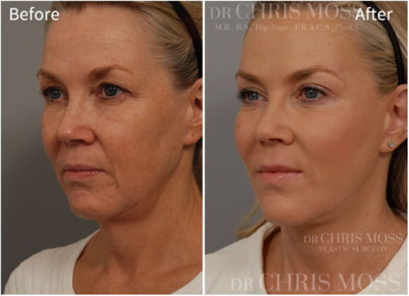 DrChrisMoss's tweet photo. Facial rejuvenation surgery before and after results. For more information visit - http://t.co/uF68sNkDPz #facelift http://t.co/QFL5VMZ0Sp