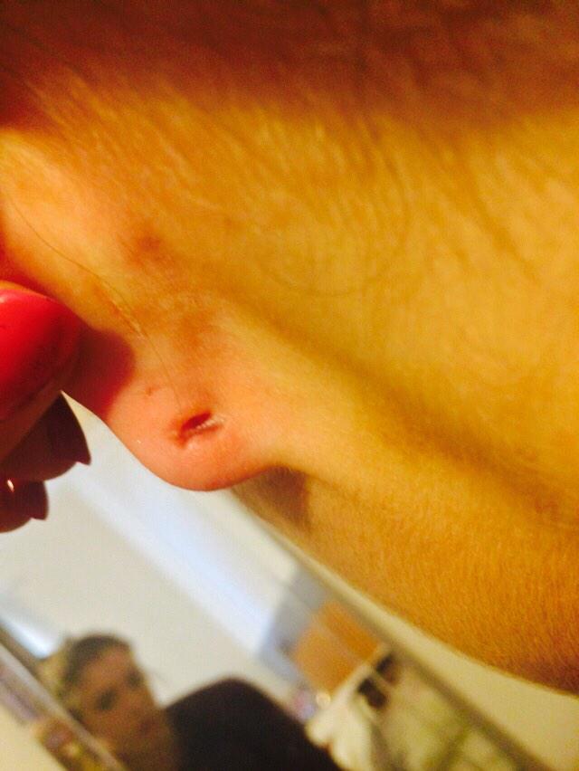 Share more than 66 earring stuck in earlobe 3tdesign.edu.vn