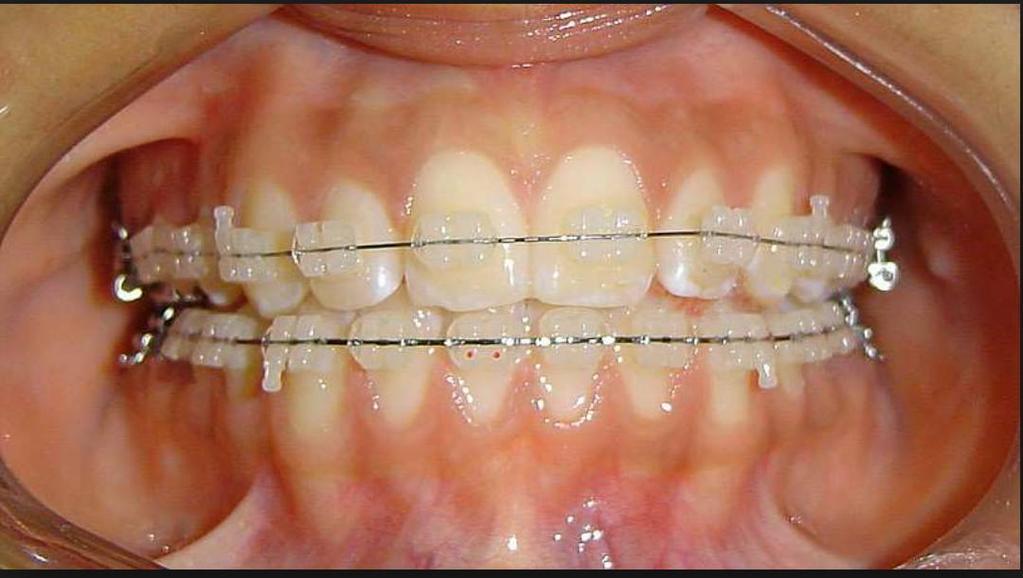 DondeirhoyEC's tweet photo. Brackets cosmeticos y metálicos, solo en @WorldSteticGye consulta GRATIS y facilidades de pago Info: @DrPeterValverde http://t.co/EDMXrcJJMK