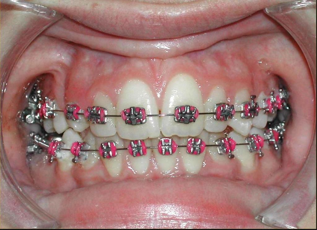 DondeirhoyEC's tweet photo. Brackets cosmeticos y metálicos, solo en @WorldSteticGye consulta GRATIS y facilidades de pago Info: @DrPeterValverde http://t.co/EDMXrcJJMK