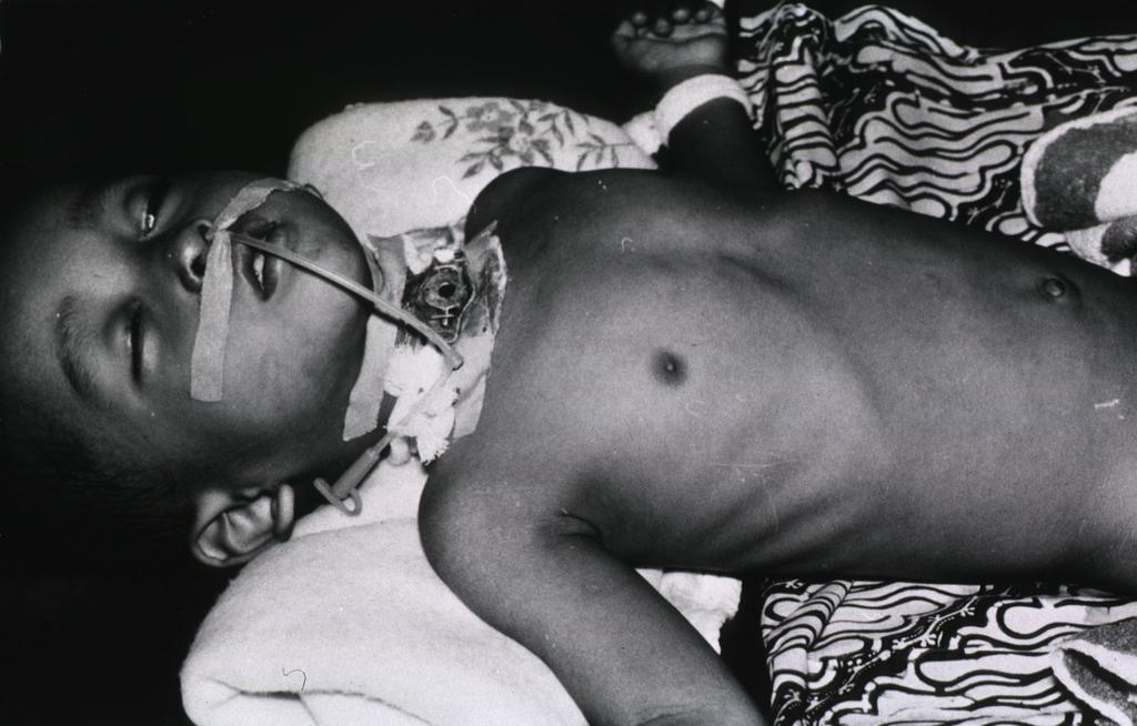 Masih menolak vaksin? | <a href="/dirgarambe/">Dirga Sakti Rambe</a>: Penyakit #Difteri dapat menyebabkan kematian. Leher anak ini harus dilubangi.