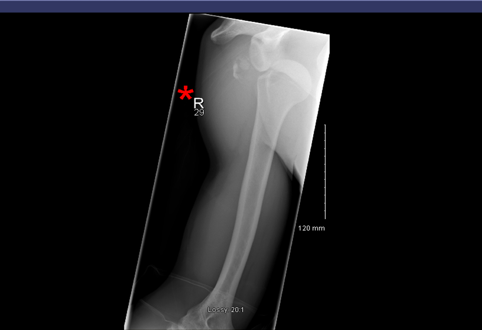 RCSI_Irl's tweet photo. Worth following @RCSIDrogheda for Prof Gillen's #PGCases. Can you guess the diagnosis? http://t.co/KDACyO5r0F