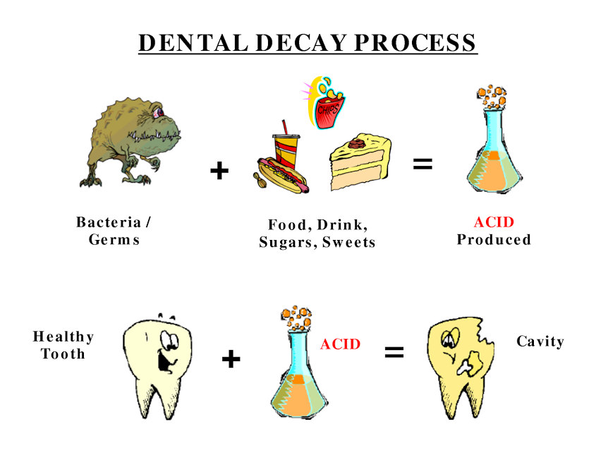 HowardFarran's tweet photo. Dental Decay Process:
Bacteria, Germs + Food, Drink Sugars, Sweets = Acid Produced
Healthy Tooth + Acid = Cavity http://t.co/iqlbxLNN1y