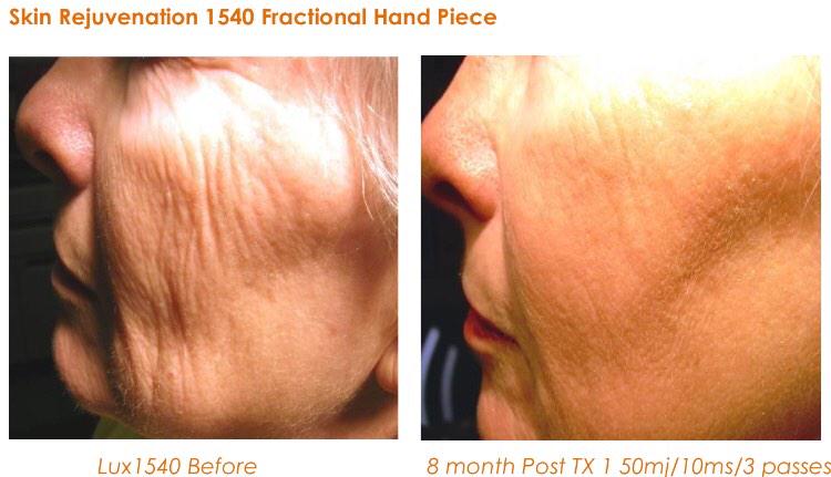 ParfaireClinic's tweet photo. Non ablative fraction laser can reduce fine lines and wrinkles in 1-2 treatments! Free consultations #BeckBromFL http://t.co/jo8Z8oY7d6