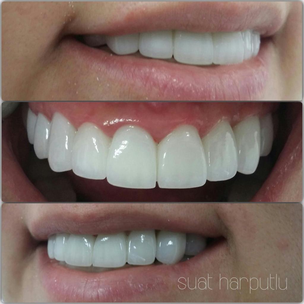 suatharputlu's tweet photo. #Smiledesing; Full #mouth #zirconium #seramics #retotation http://t.co/0FpQw38JdS