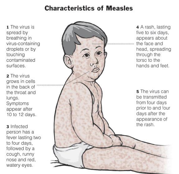 DailyHealthTips's tweet photo. The #Measles outbreak in #Disneyland.
Here's how you can prevent the spreading #infection - http://t.co/em8JKkyDHQ http://t.co/ZJyBFpY7Yk