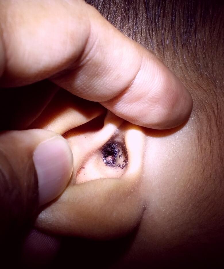 drmauroof's tweet photo. So much for my wish that I don't see a kid with cotton bud injury today. Keep them out of their reach. 
#ENTpractice http://t.co/S8k3mS4fEq
