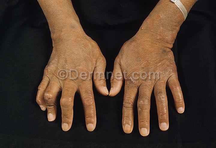 UsizeAfrica's tweet image. Yesterday was World Leprosy Day - a disease is still surrounded by stigma. #aidanddevelopment