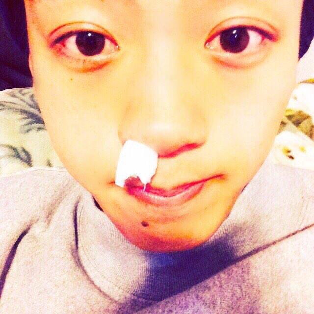 竹内涼真 少し鼻をほじったら鼻血が止まりません たすけて 笑 Http T Co Ehqtbrb6km