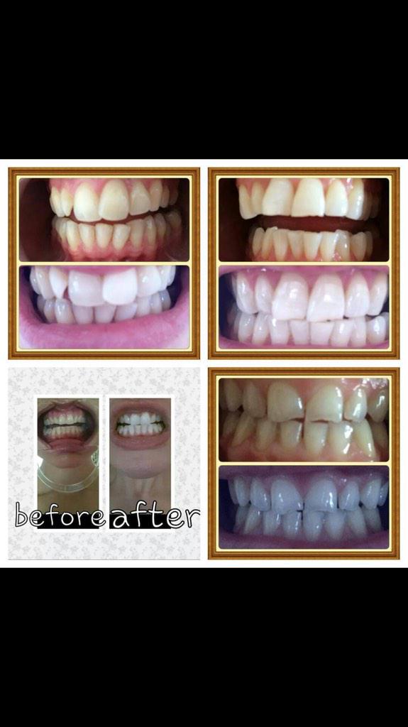 Book you pearly whites in now! Just £30 instead of £99! Drop 8-14 shades in one session 😘