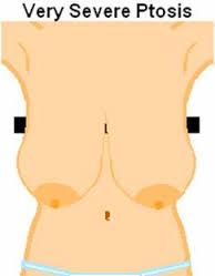 Gidi_Traffic's tweet photo. "@TheProLogic1: #Breastsagging
Smoking reduces d amount of collagen in d skin &makes d skin become weaker&age faster http://t.co/aWKGCZDpw0