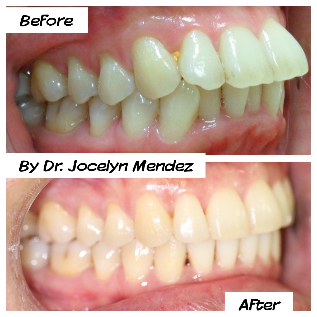 GroveDentist's tweet photo. Great @Invisalign results by Dr. Mendez. Teeth "sticking out" ? Give us a call 305-460-4499 #miami #miamidentist http://t.co/Ix8YBA5upQ